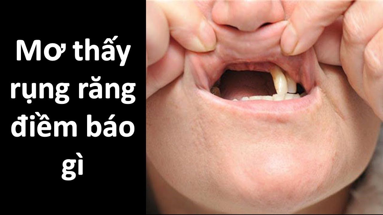 mơ rụng răng